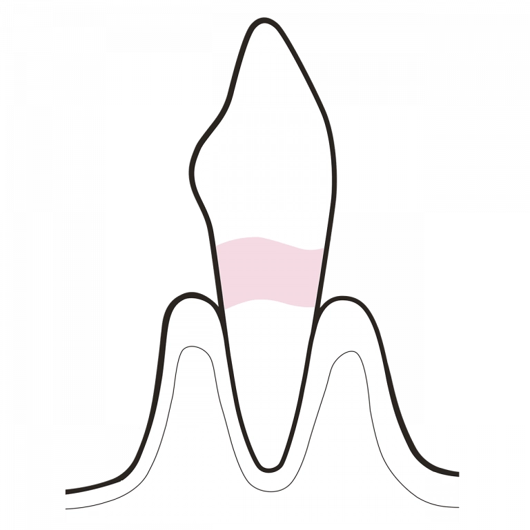 Exposed dentine