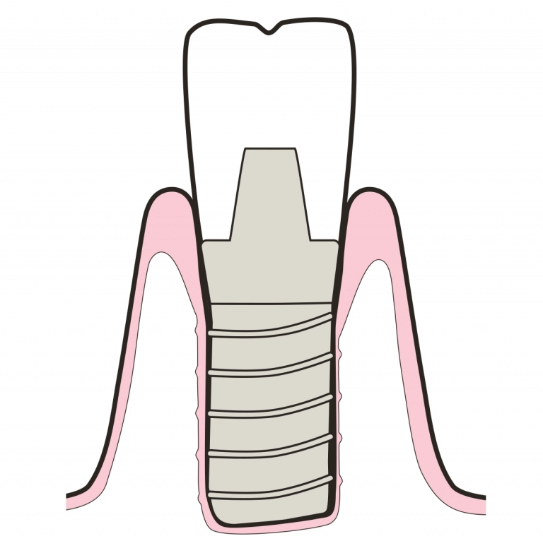 Implants