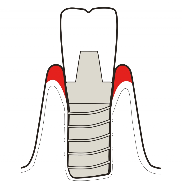 Mucositis