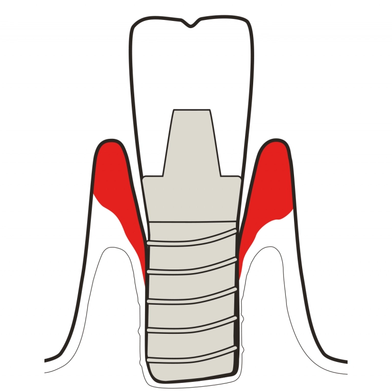 Peri-implantitis