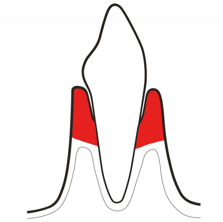 Periodontitis