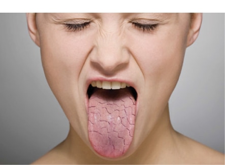 woman with dried out tongue