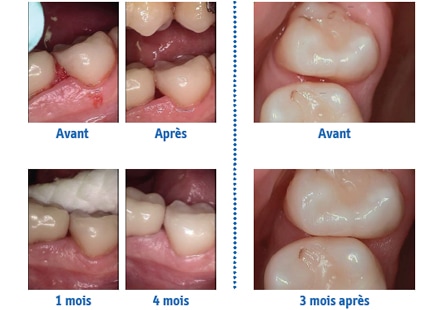 Les brossettes interdentaires : quand ? comment ? #2 – L